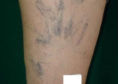 Esclerosis 2 (Antes)