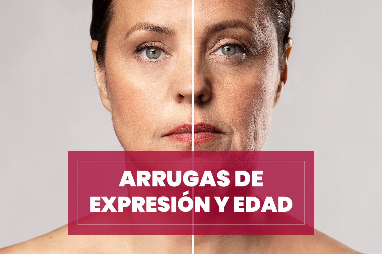 arrugas-expresion-edad Arrugas de expresión y edad