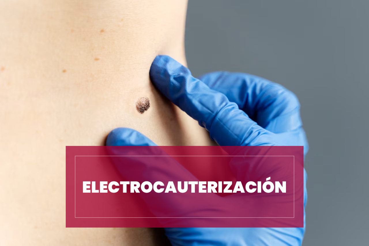 Electrocauterización