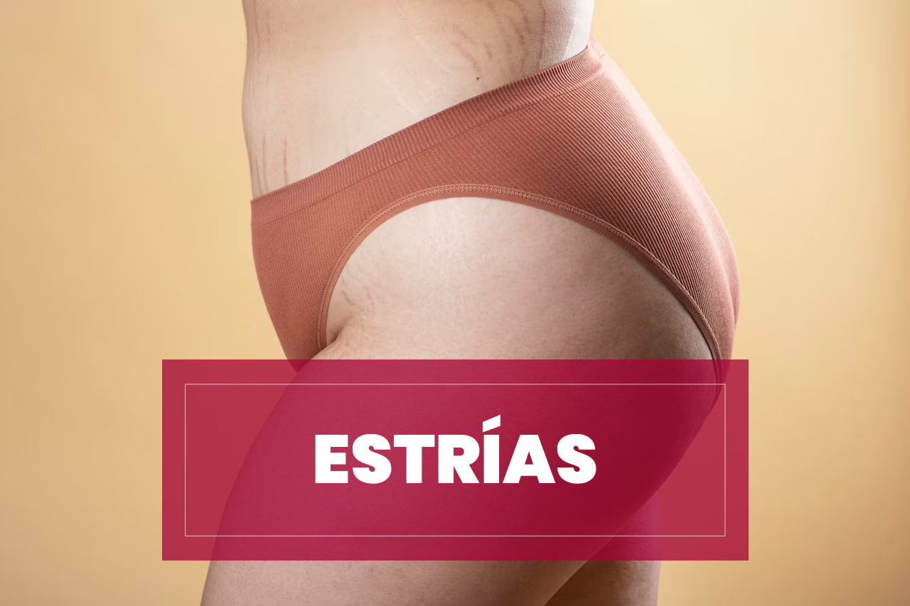 Estrías