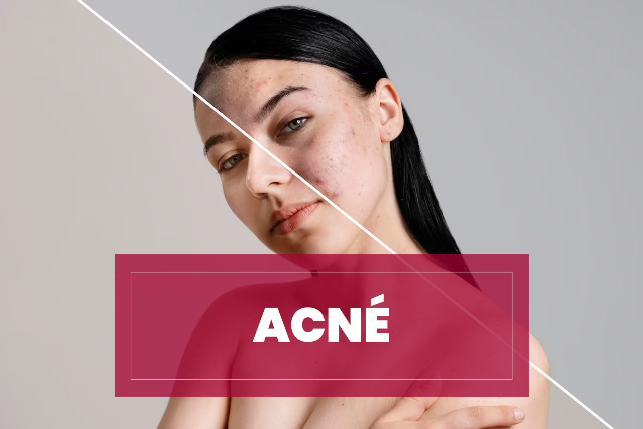 tratamiento-acne Tratamiento Acné