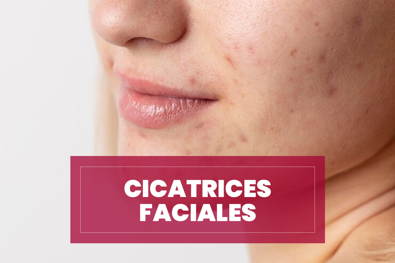 cicatrices-faciales Cicatrices faciales