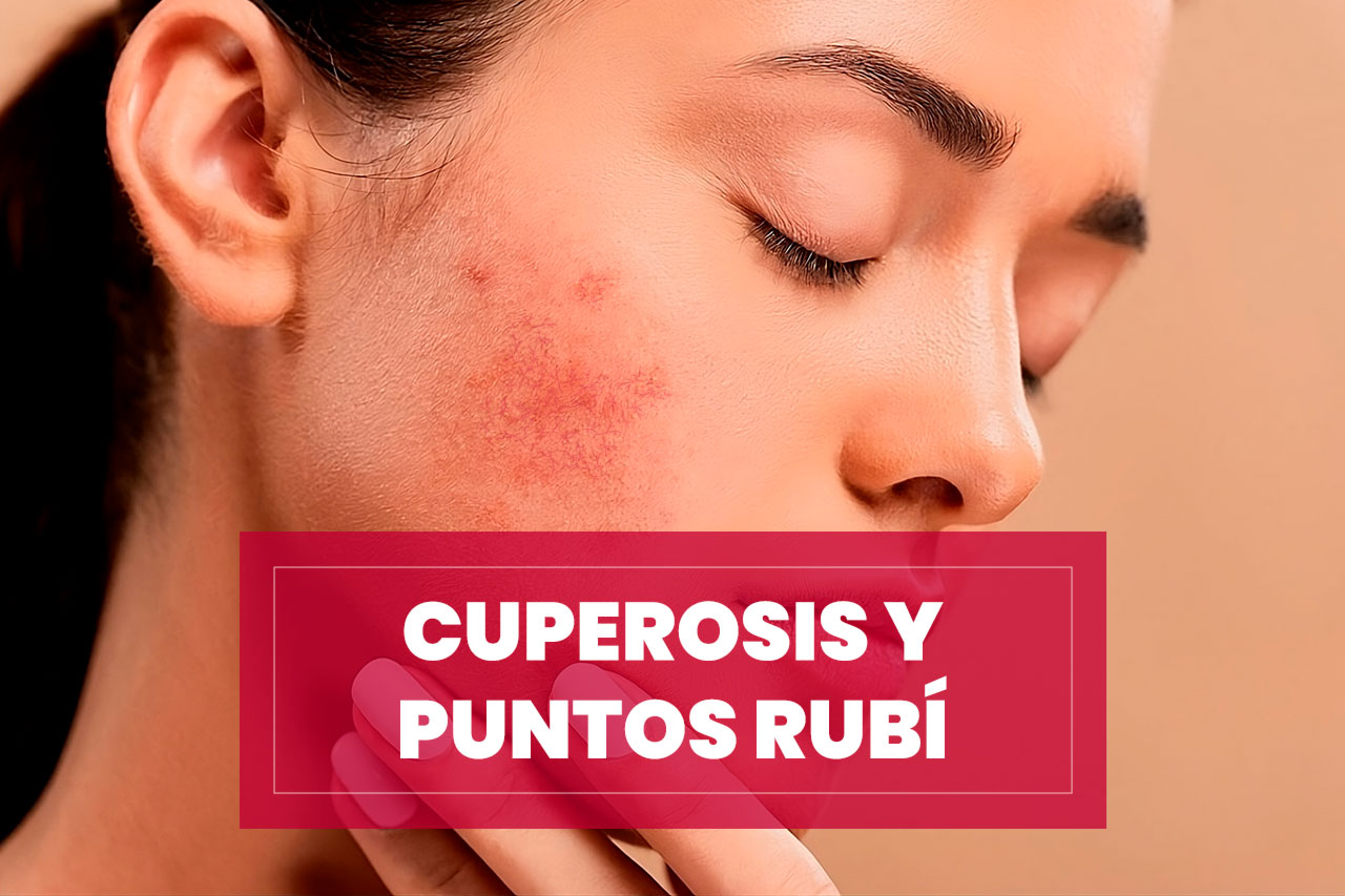 cuperosis-puntos-rubi Tratamiento para la Cuperosis y Puntos Rubí