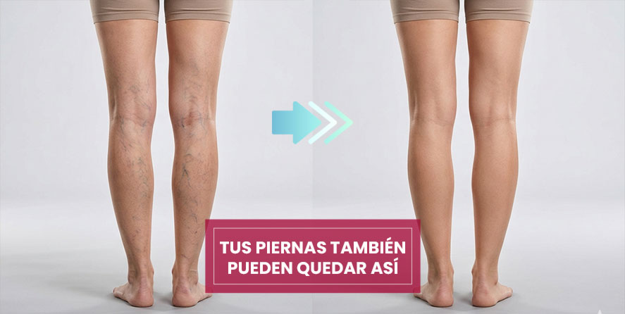 Antes y después del tratamiento de varices en Córdoba