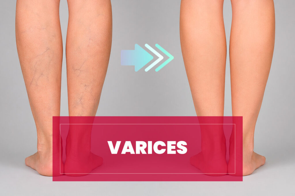Tratamiento de Varices