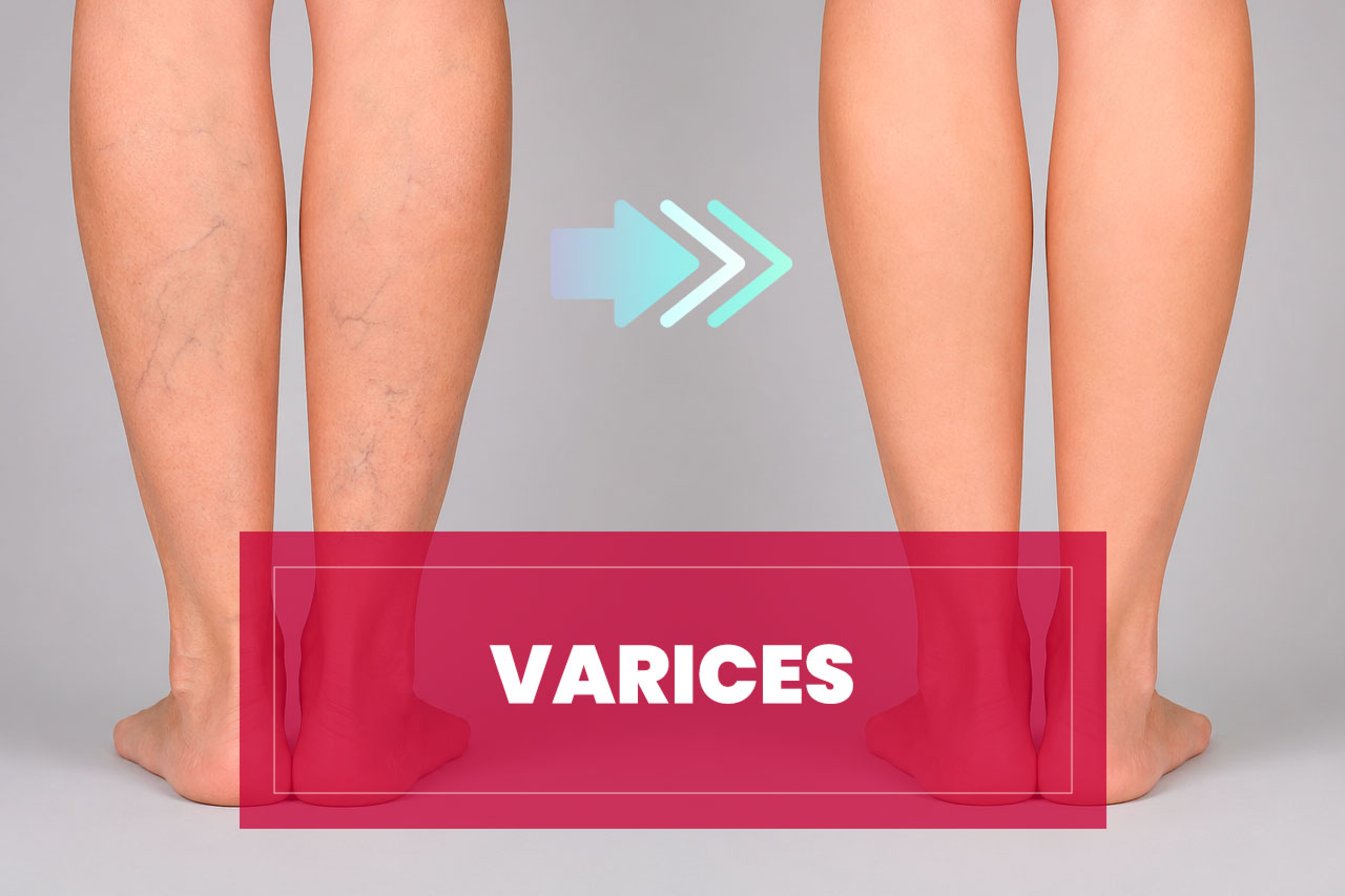 Tratamiento de Varices
